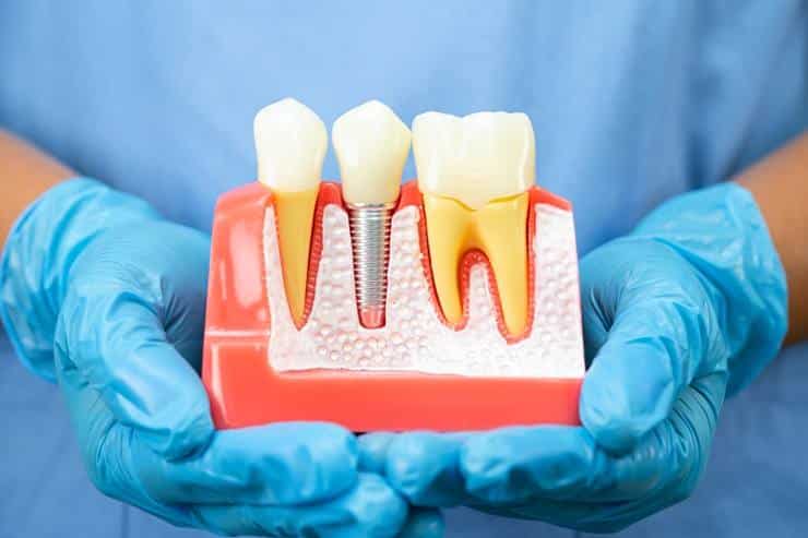 dentist holding dental implant